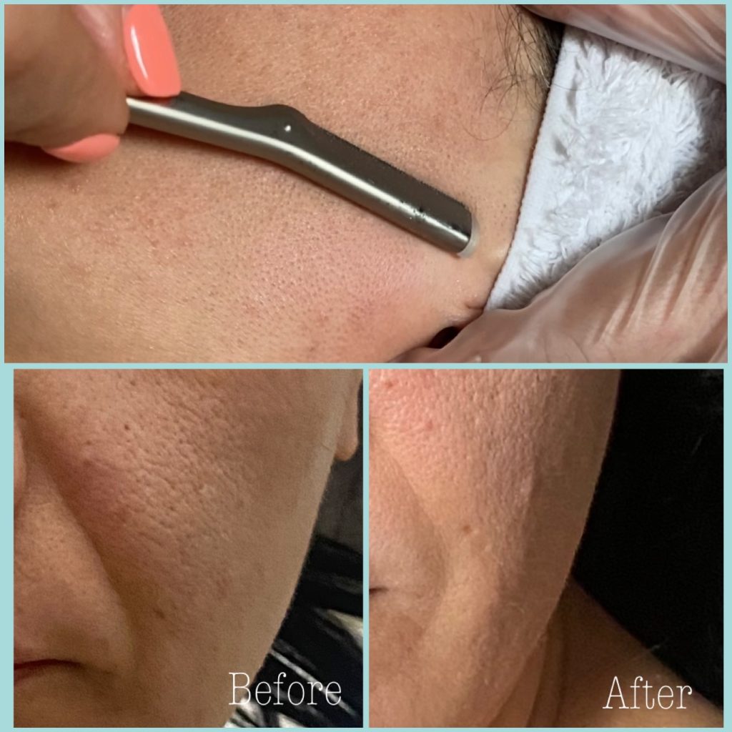 Dermaplaning (2)