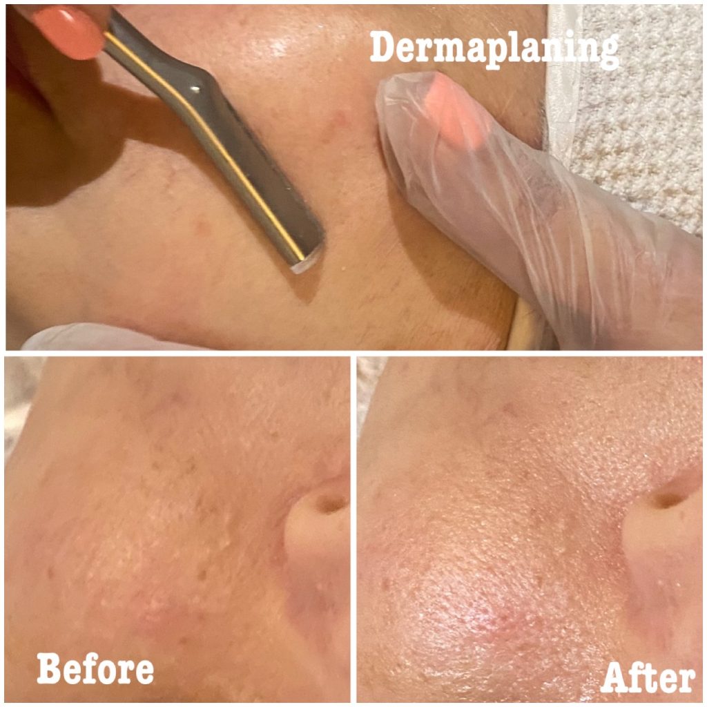 Dermaplaning (3)