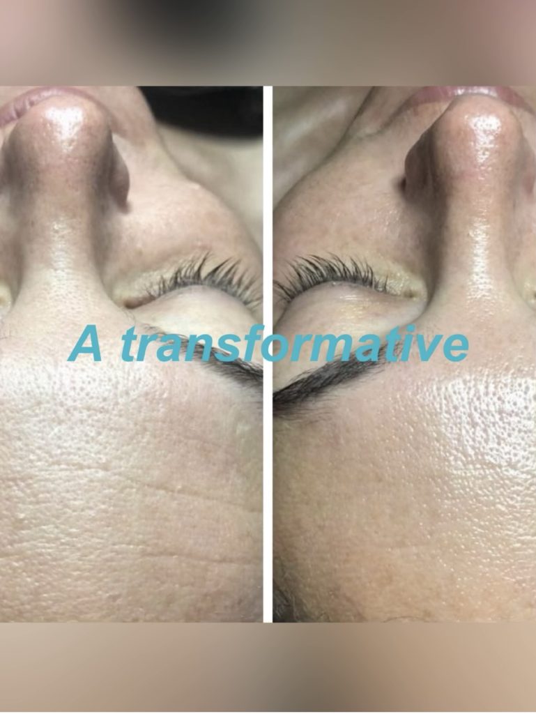 HYDRAFACIAL 6 IN 1 treatment (2)